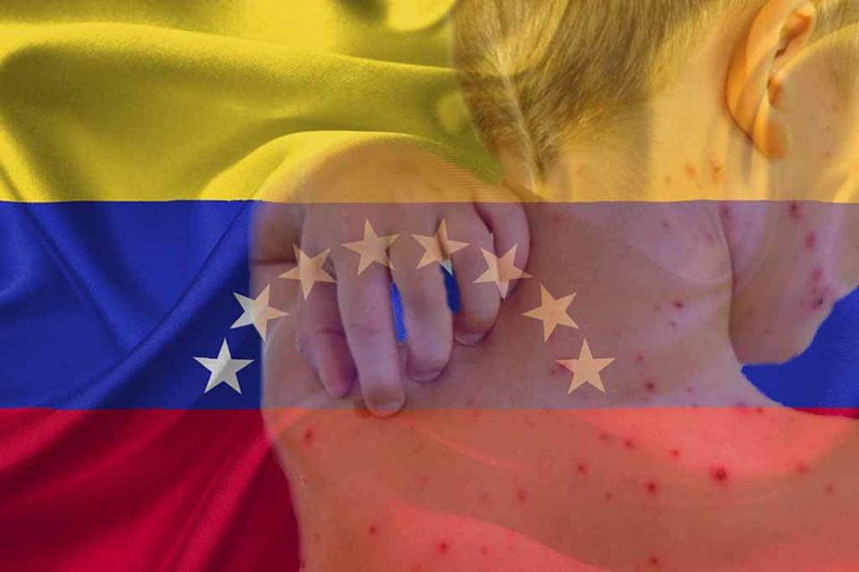 Alertan sobre epidemia de sarampión en grupo indígena venezolano Alertan sobre epidemia de sarampión en grupo indígena venezolano