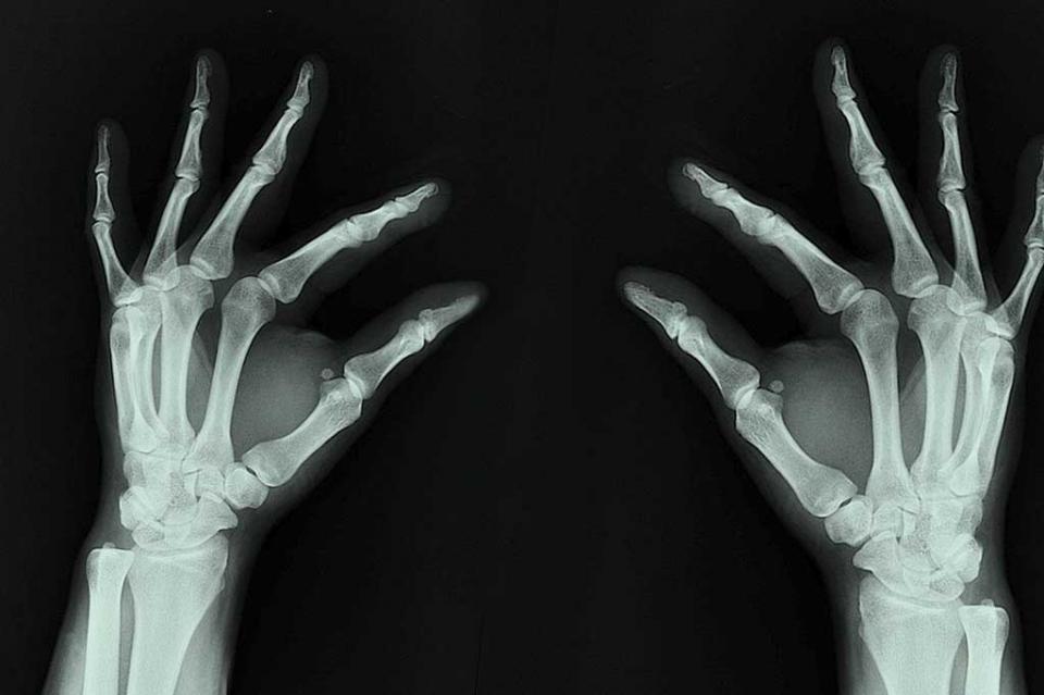 Uno de cada cinco hombres mayores de 50 años padece osteoporosis Uno de cada cinco hombres mayores de 50 años padece osteoporosis
