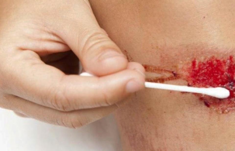 Generan biotecnología basada en células madre para curar heridas Generan biotecnología basada en células madre para curar heridas